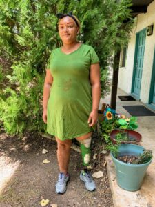 Woman in green dress with leg prosthesis